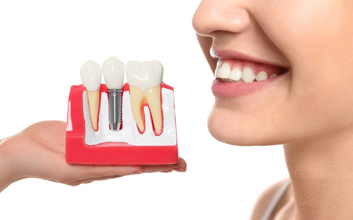 Ways to find affordable dental implants